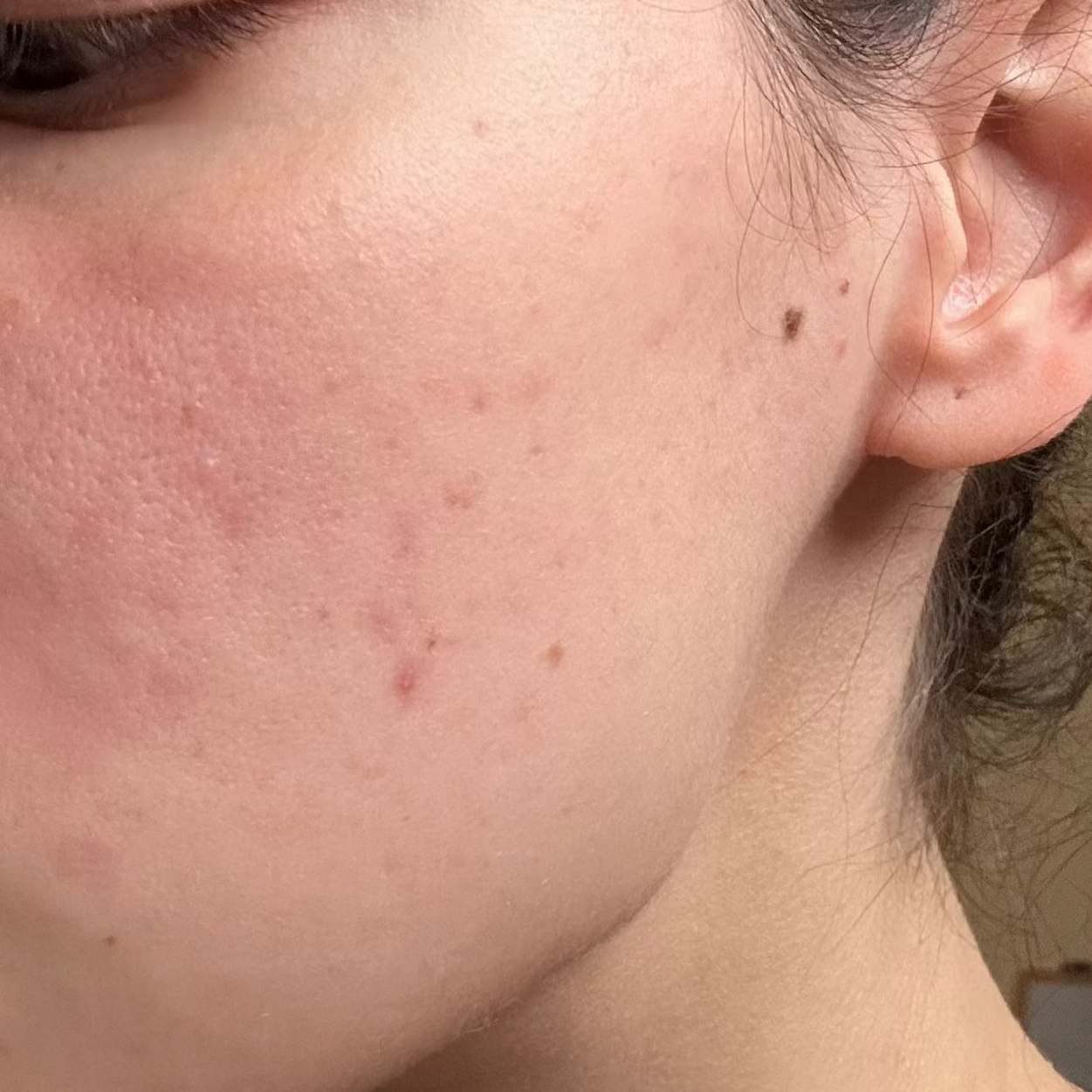 Close-up of a person's cheek and ear showing skin texture, pores, and a few small blemishes and moles.