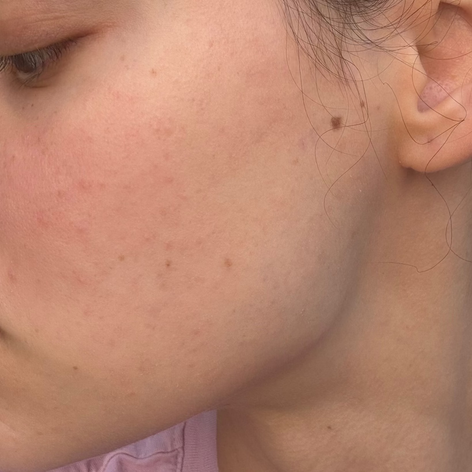 Close-up side profile of a woman's face showing her cheek, ear, jawline, and neck, with a small dark mole on her cheek.