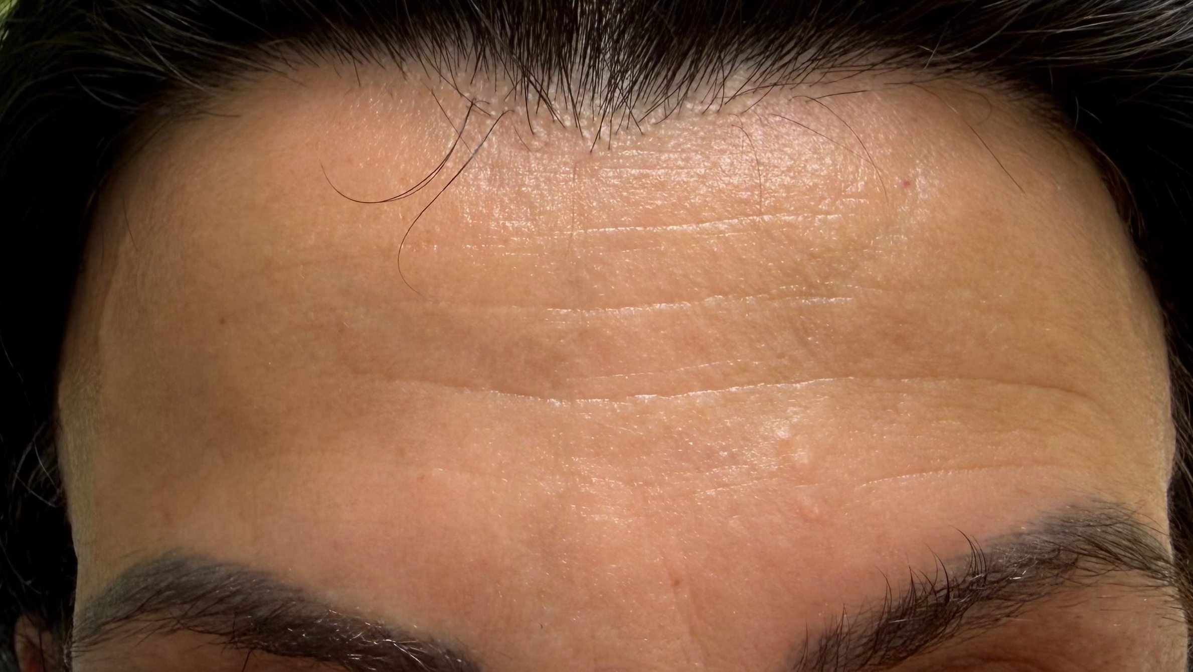 Close-up of a person's forehead showing horizontal forehead wrinkles, with dark hair and eyebrows.